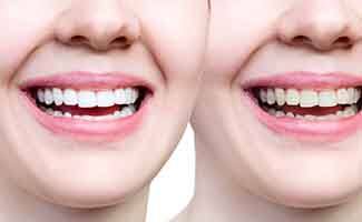 Before and after of cosmetic dentistry