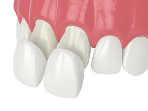 Illustration of veneers being placed on teeth